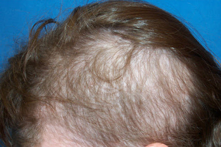 اختلال موکَنی در کودکان